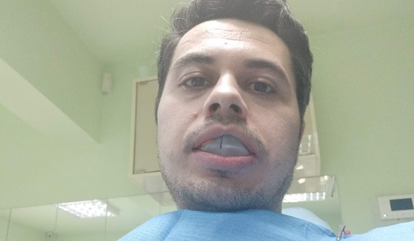 Cam asa aratam in timp ce se lua amprenta dentara